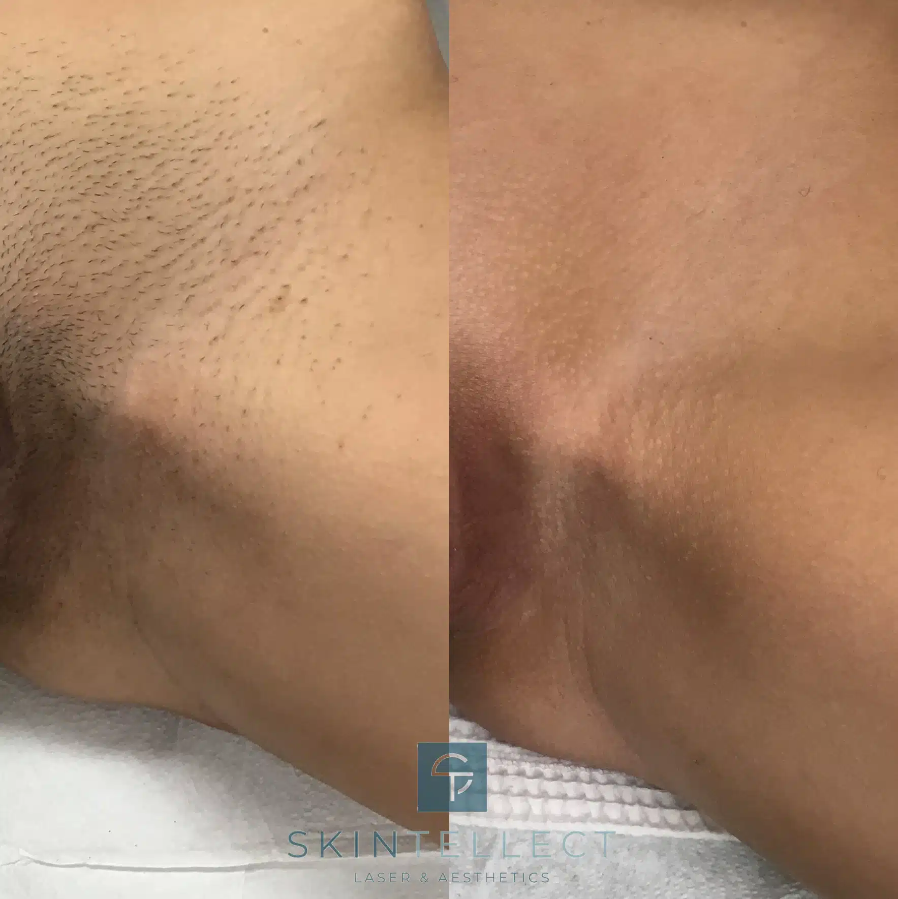 Laser Hair Removal Before & After