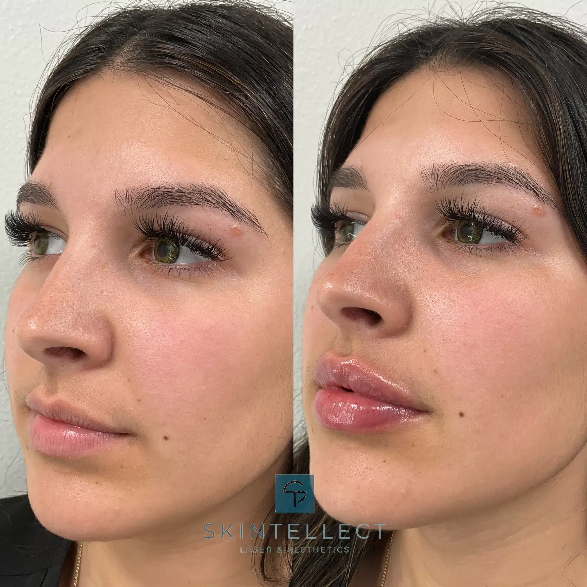 Before and after lip filler treatment at Skintellect Laser & Aesthetics