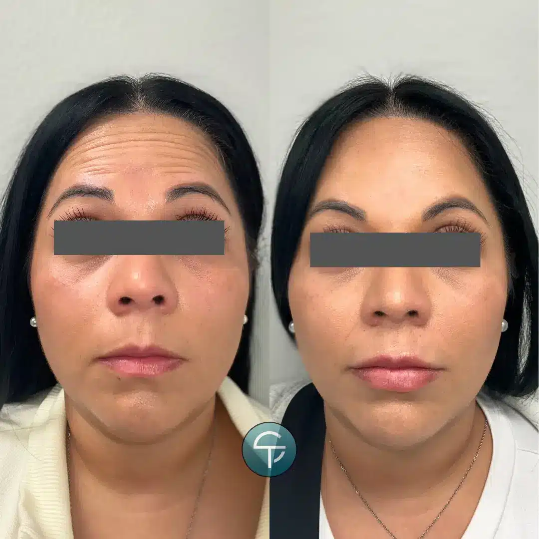 Forehead before and after Botox treatment, showing a dramatic reduction in lines and wrinkles for a smooth, rejuvenated look.