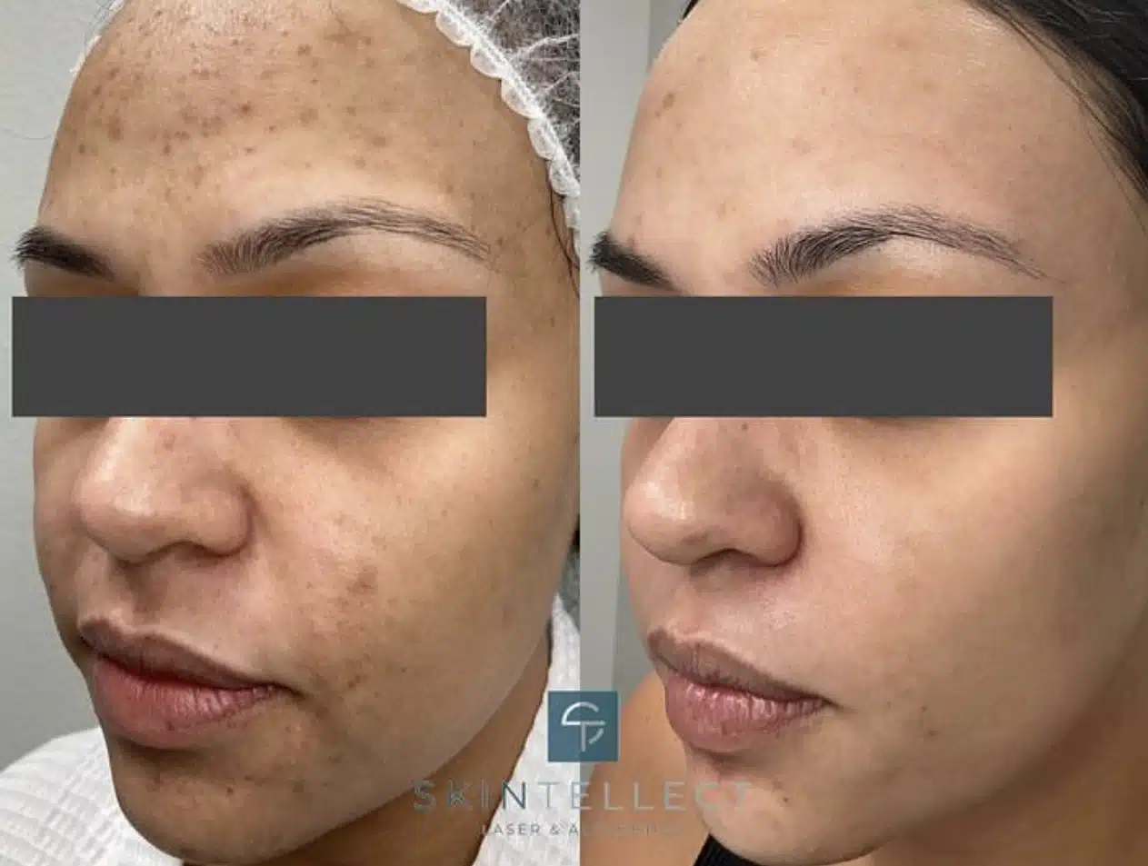 Before and after photo of laser pigment removal treatment targeting melasma.