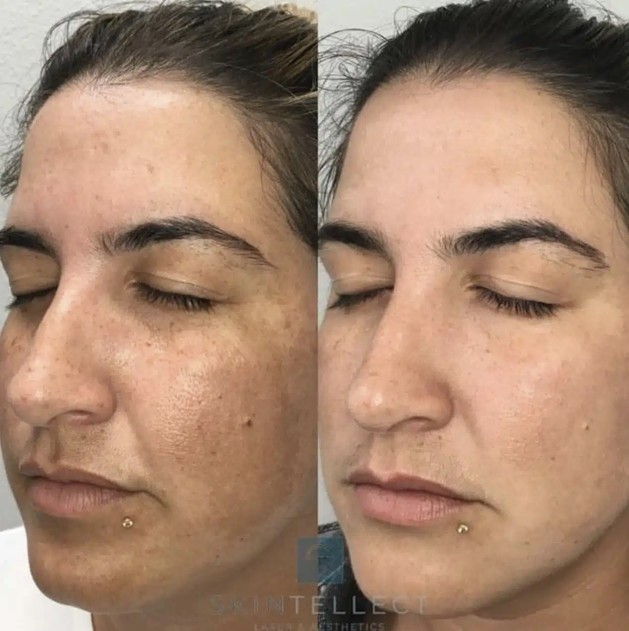 Before and after laser pigment removal treatment reducing dark spots and discoloration.