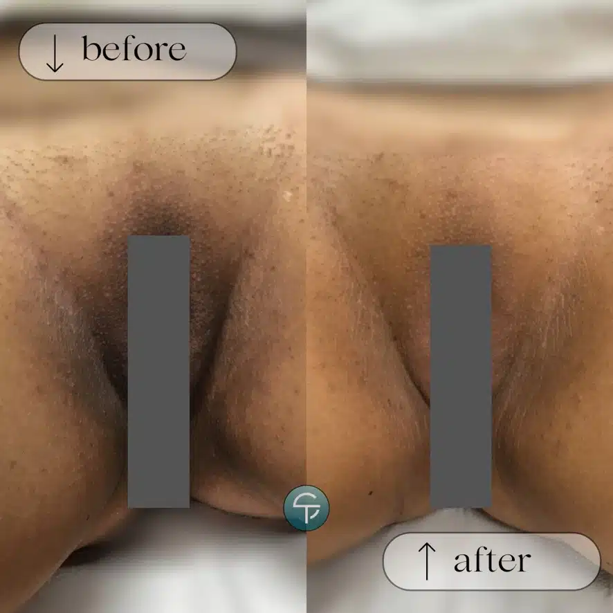Intimate Skin Lightening