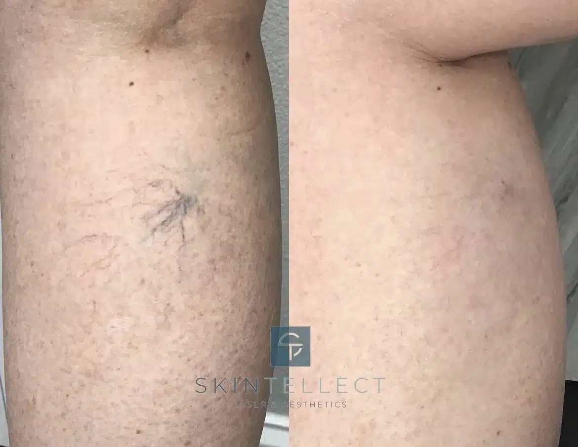 Before and after laser spider vein removal at Skintellect Laser & Aesthetics in Tampa