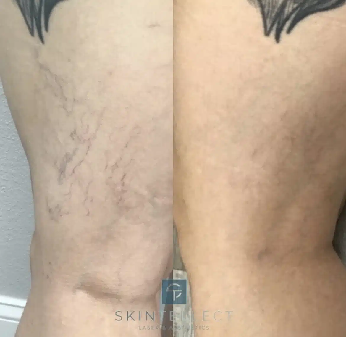Before and after spider vein removal treatment at Skintellect Laser & Aesthetics in Tampa