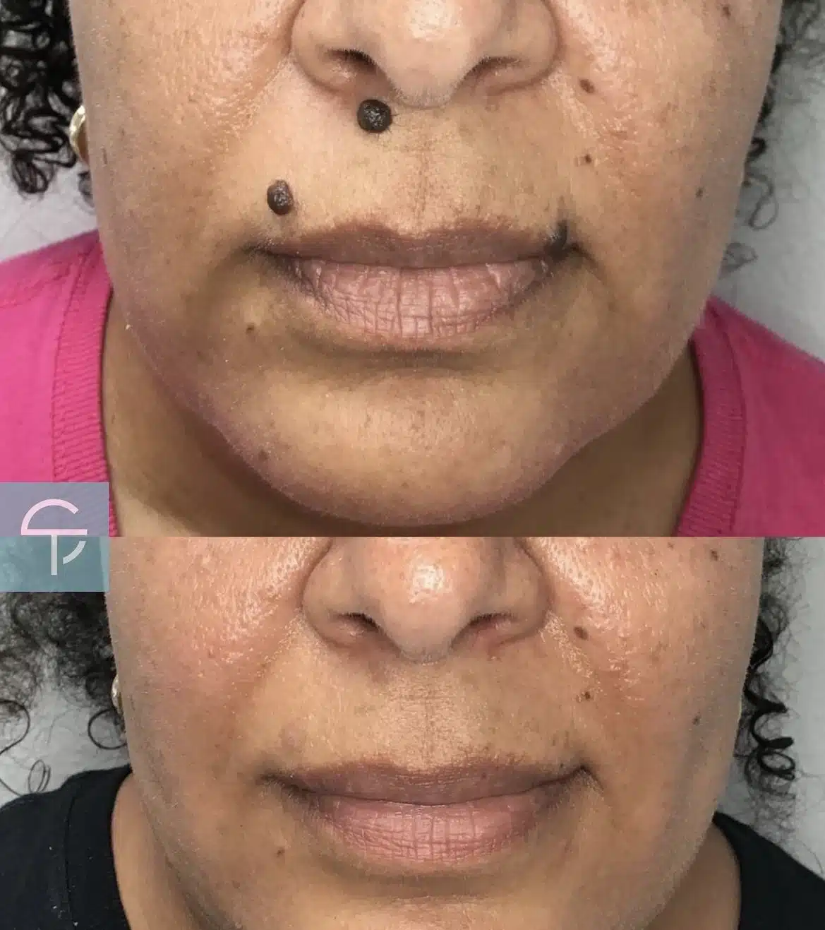 Before and after large mole removal on face Tampa