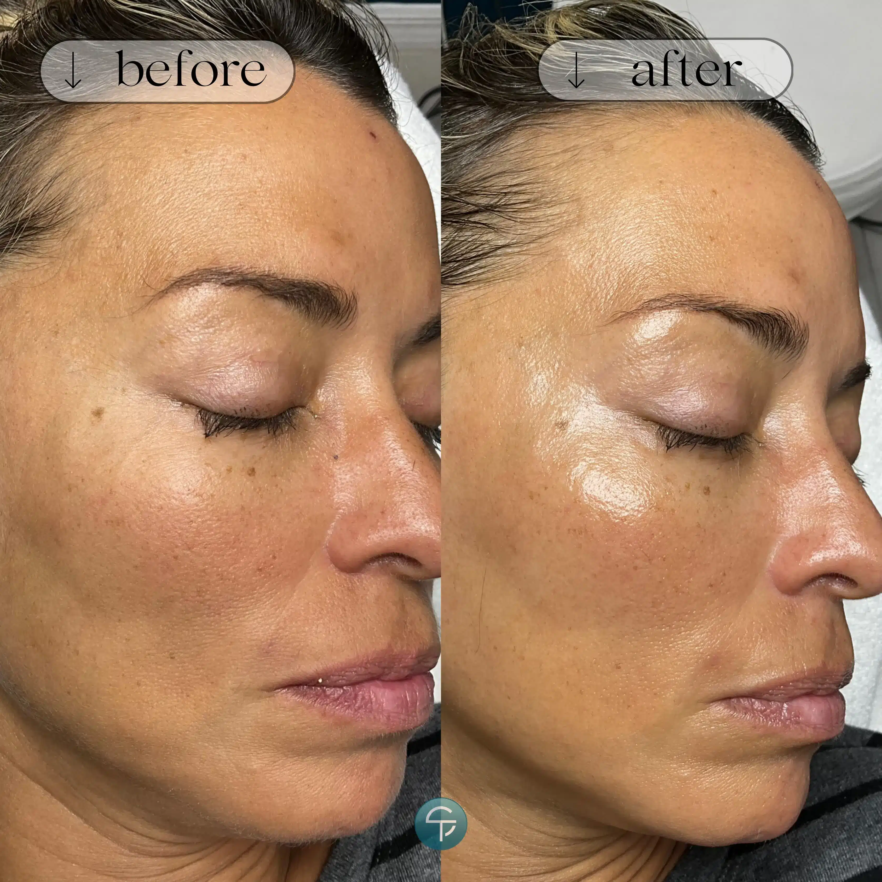 Before and after Dermaplaning showing glowing, smooth skin with removed dead skin cells and peach fuzz.