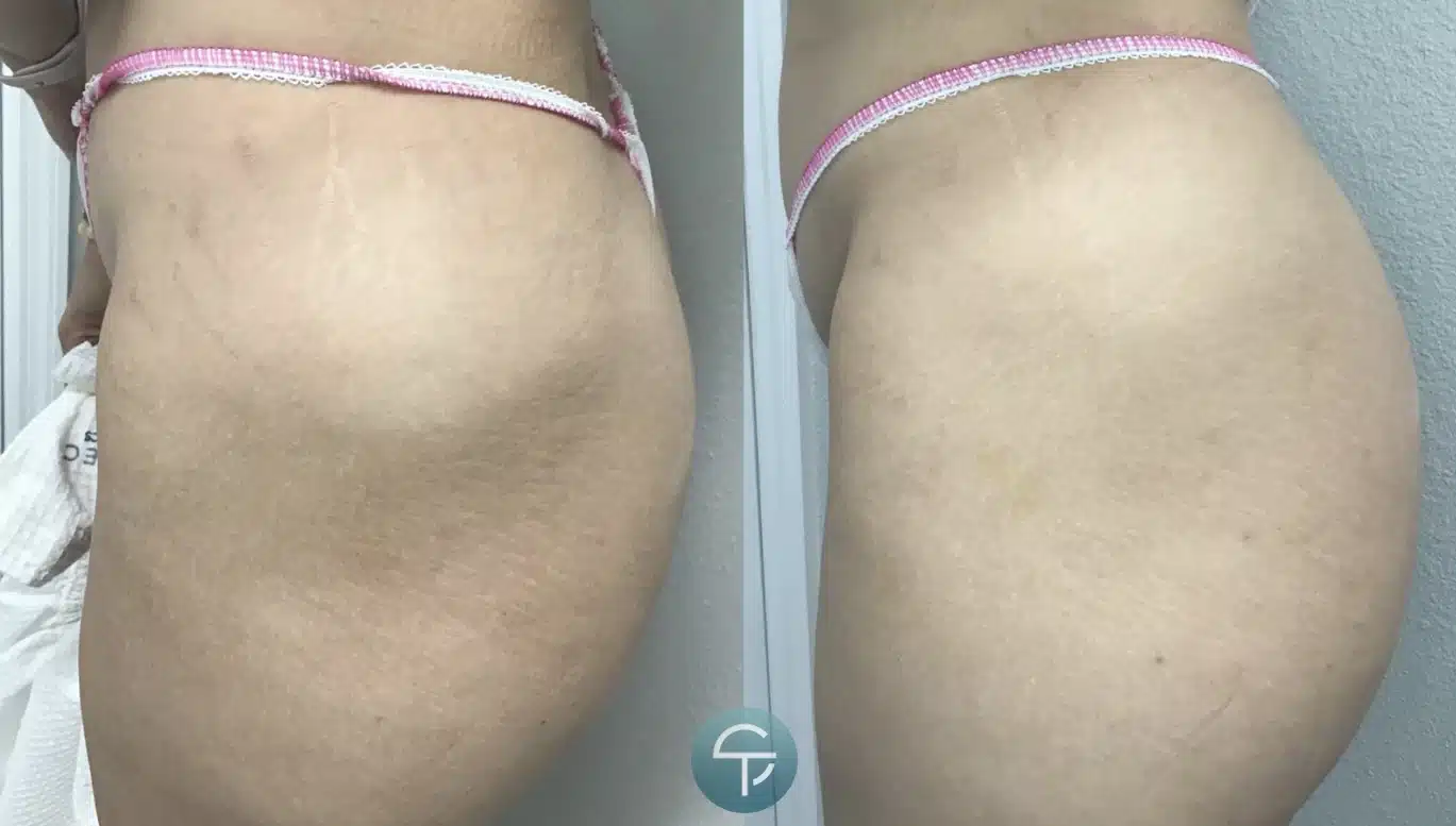 Before and after photo of hips treated with MultiShape Body Contouring, showing smoother and more sculpted skin.