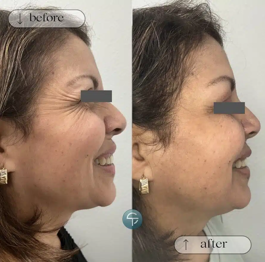 Botox