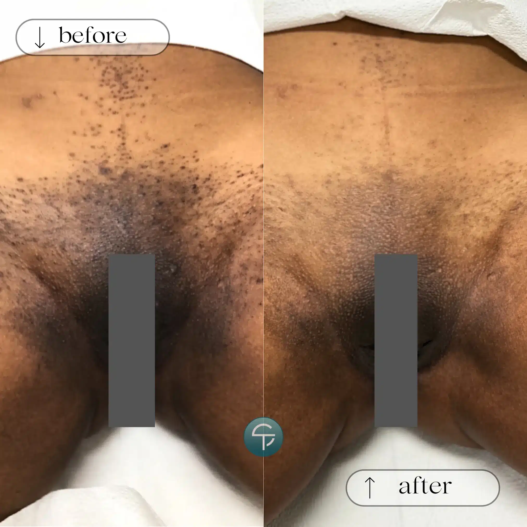 Brazilian laser hair removal for dark skin tone in Tampa