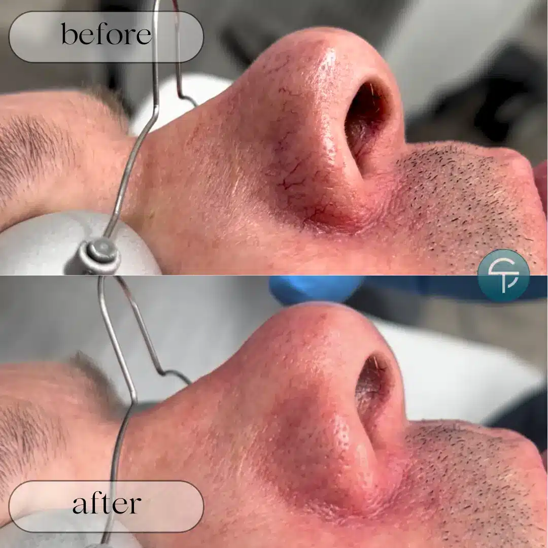 Before and after treatment for broken capillaries and nose veins at Skintellect Laser & Aesthetics in Tampa