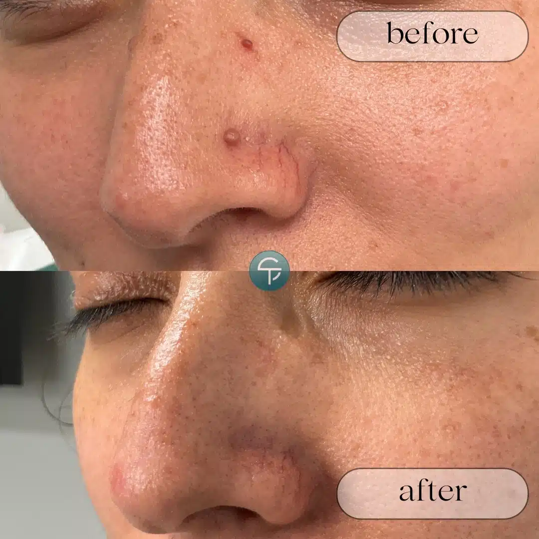 Before and after mole removal on nose