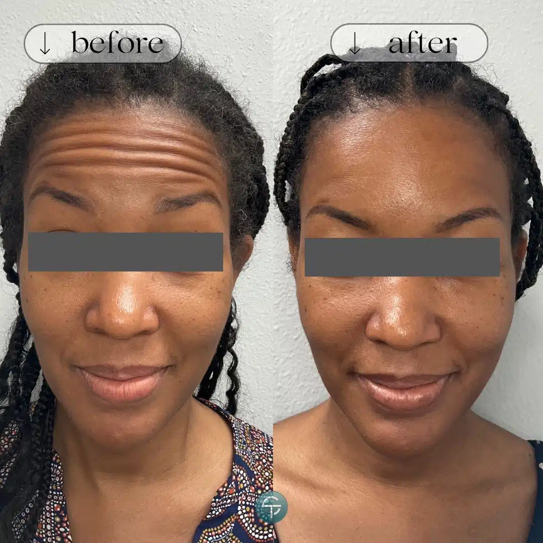 Before and after Botox treatment at Skintellect Laser & Aesthetics