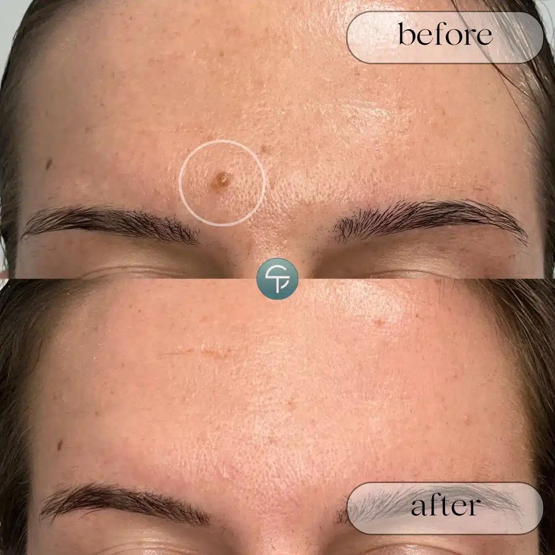 Before and after forehead mole removal results