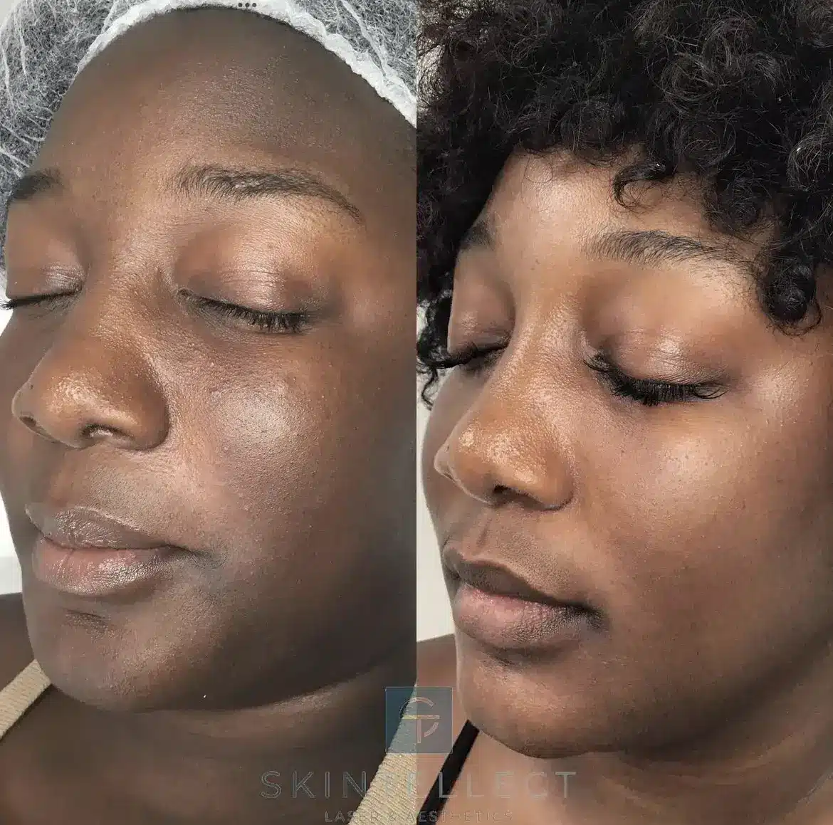 Before and after laser pigment removal showing improvement in overall skin tone.