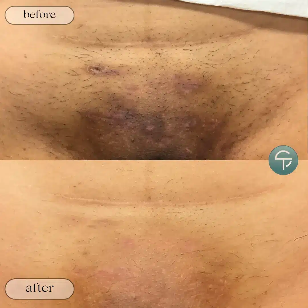 Brazilian laser hair removal treatment in Tampa