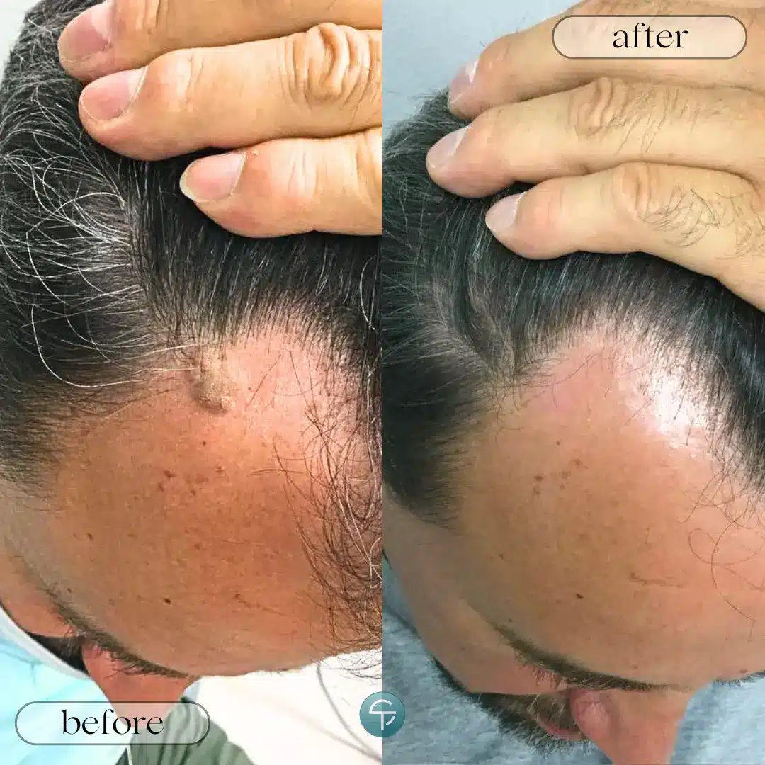 Before and after mole removal on hairline by Skintellect Laser & Aesthetics Tampa