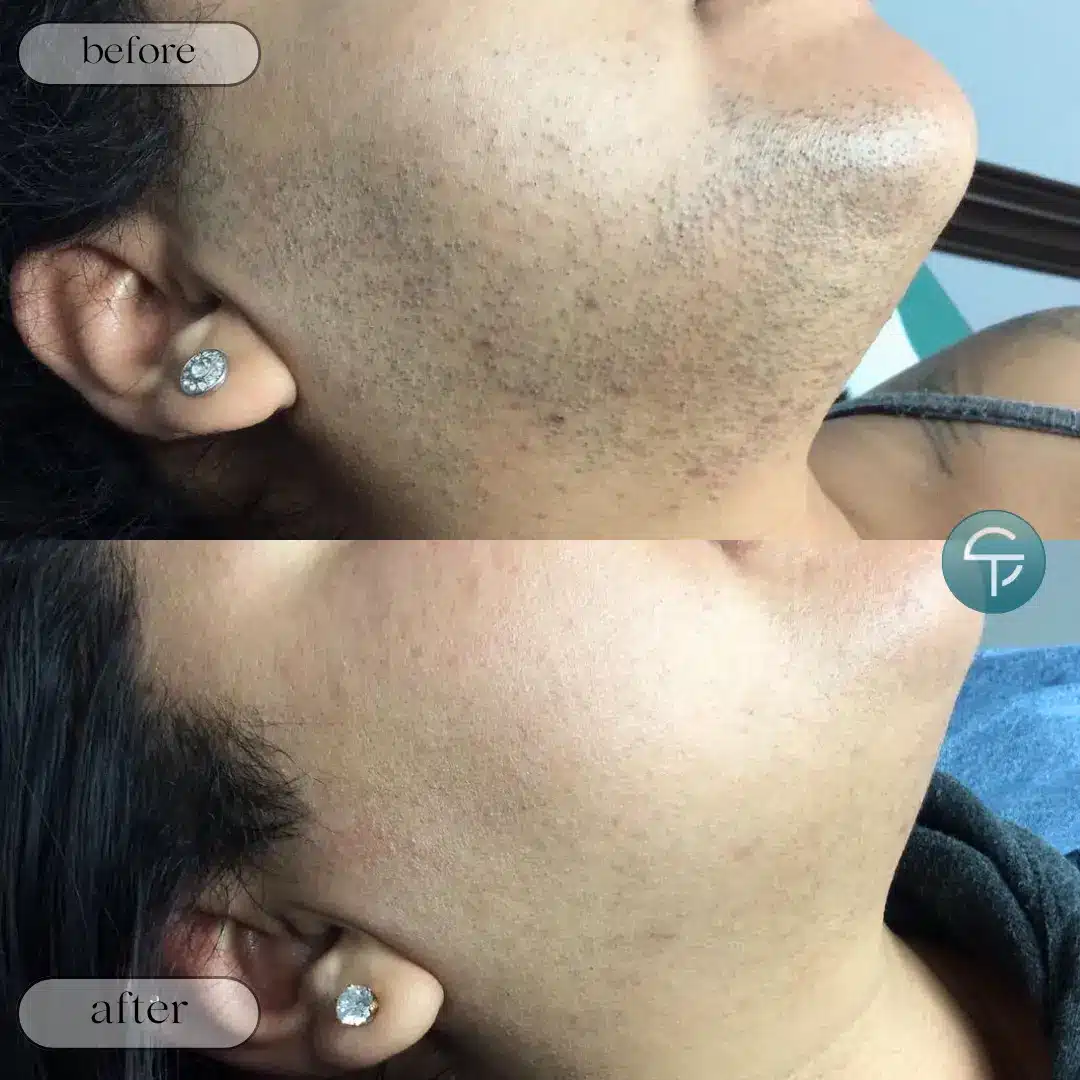 Laser hair removal for women with PCOS in Tampa