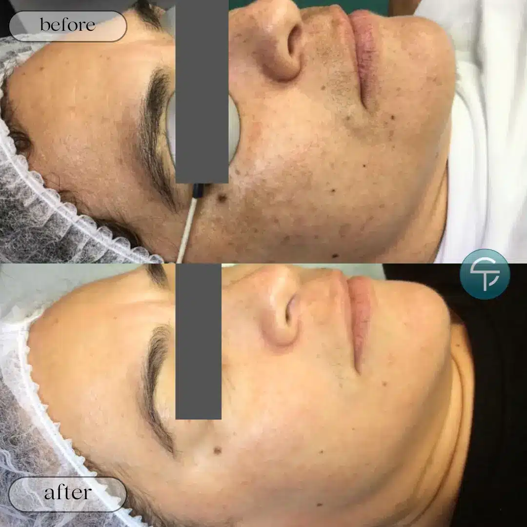 Before and after results of laser pigment removal for melasma and dark patches.