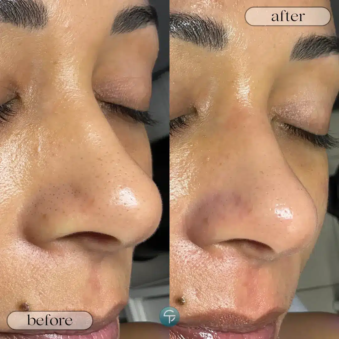 Before and after Hydrafacial showing cleared blackheads and smoother skin.