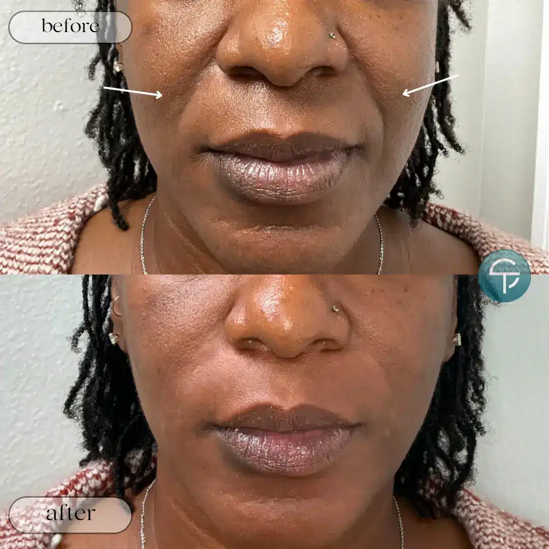Dermal Filler | 2 Syringes