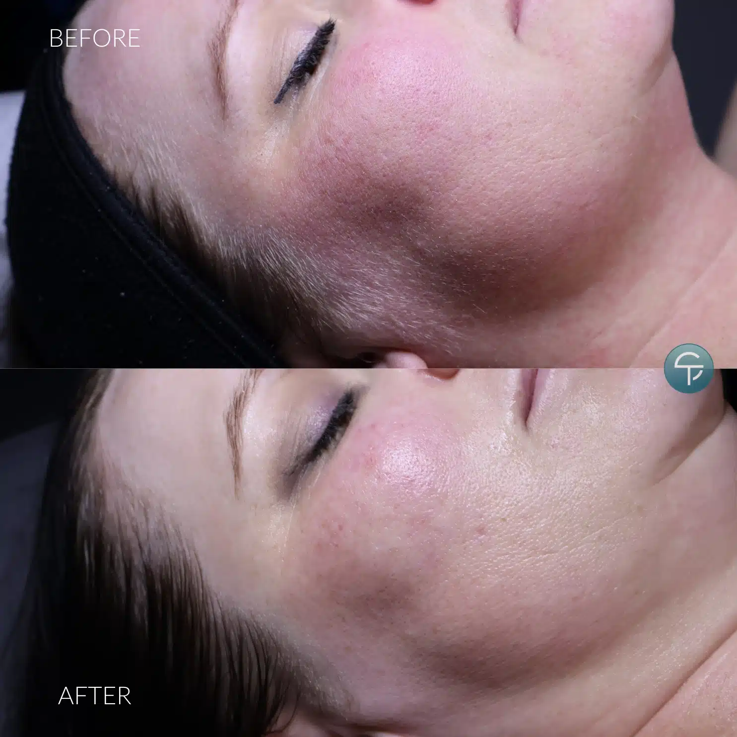 Close-up of face before and after dermaplaning, showing the removal of peach fuzz for smooth, radiant skin.