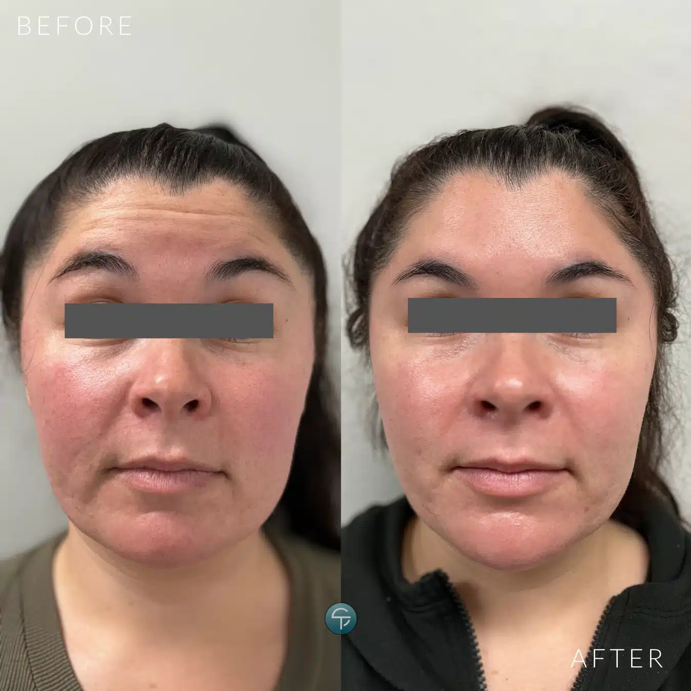 Forehead before and after Botox treatment, with visible reduction of fine lines and wrinkles for a smoother, youthful appearance.