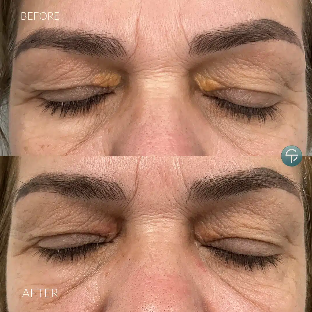 Close-up of clear, smooth skin after syringoma removal treatment.