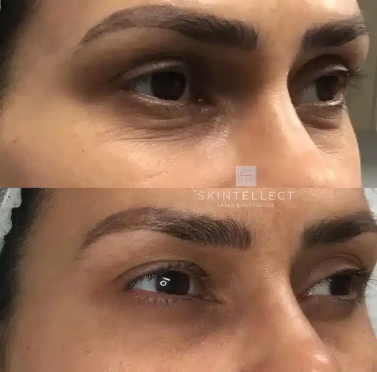 Fotona SmoothEye before and after showing firmer, youthful skin around the eyes