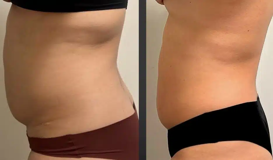 Before and after of Multishape body contouring treatment on the abdomen, showing noticeable fat reduction and improved skin tightness.