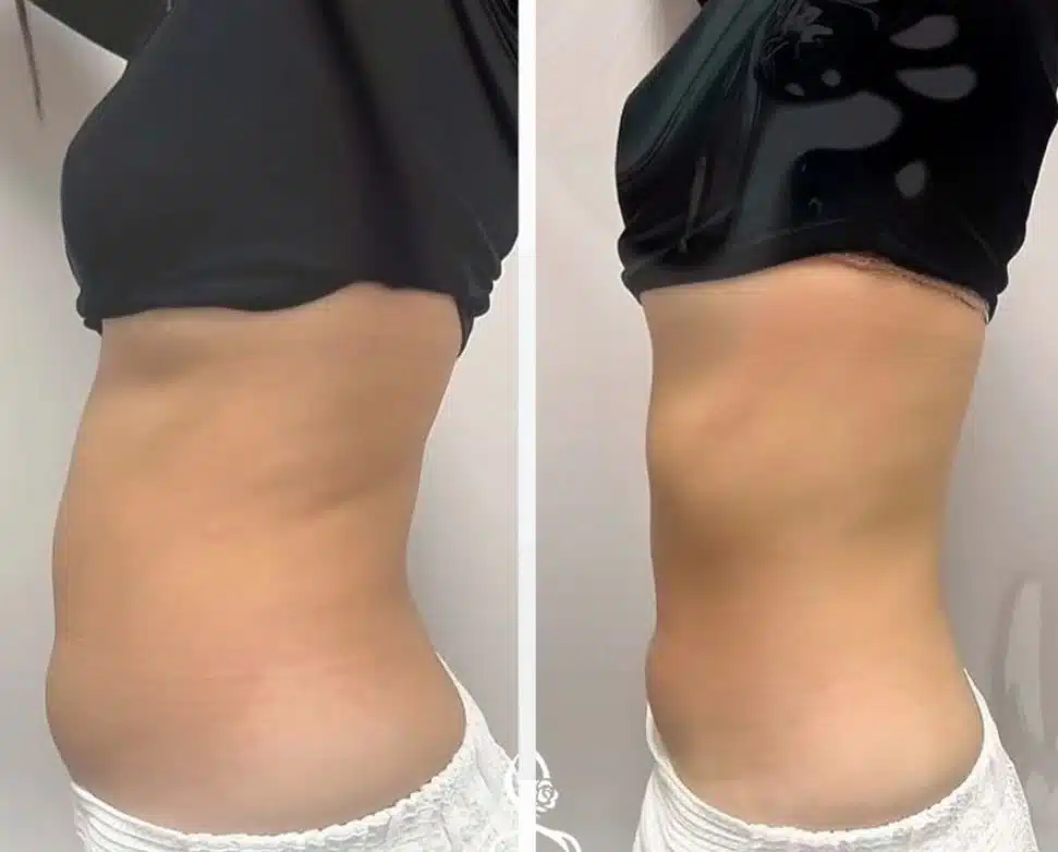 Before and after photos of a Multishape body contouring treatment on the abdomen, showing enhanced definition and reduced bloating.
