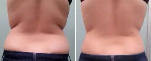 Flanks after Fotona TightSculpting showing a reduction in fat rolls and enhanced skin firmness.
