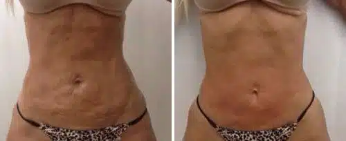 Abdomen after Fotona TightSculpting showing improved skin tightness and tone.