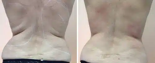 Flanks treated with Fotona TightSculpting showing reduced fat rolls and tighter skin.