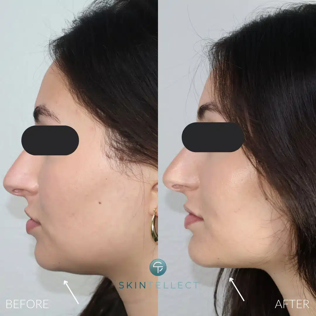 Chin Filler before and after results for a more contoured jawline