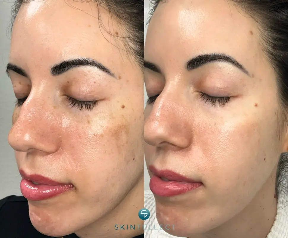 Before and after photo showing laser pigment removal treatment reducing dark spots and hyperpigmentation on the face.