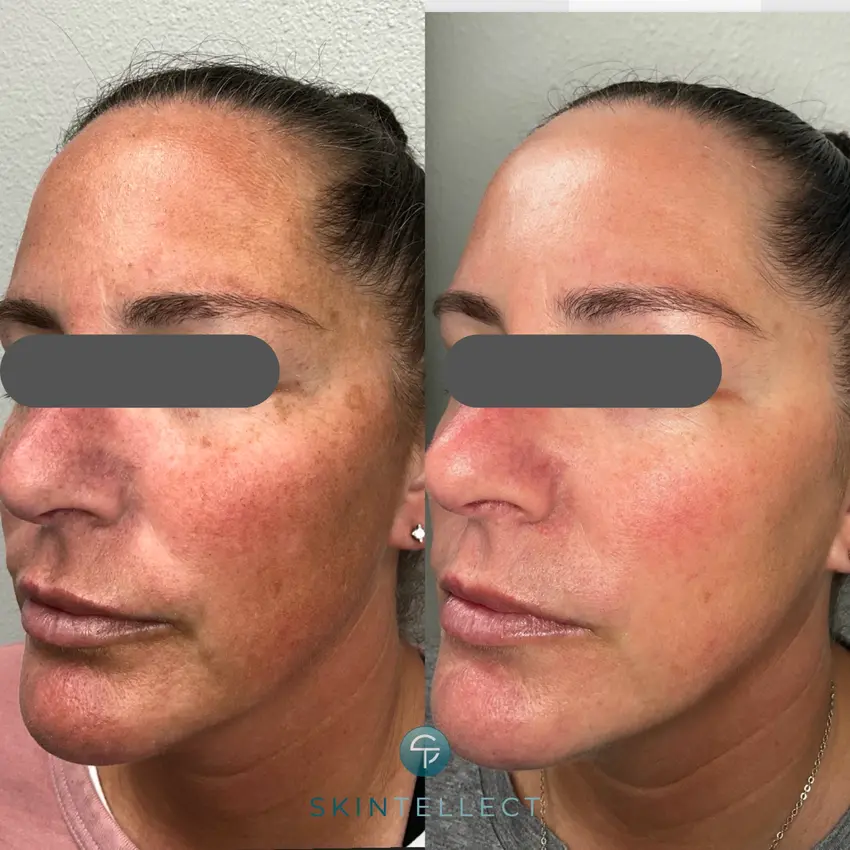 Laser pigment removal treatment targeting facial redness and dark spots for clearer, more even-toned skin.
