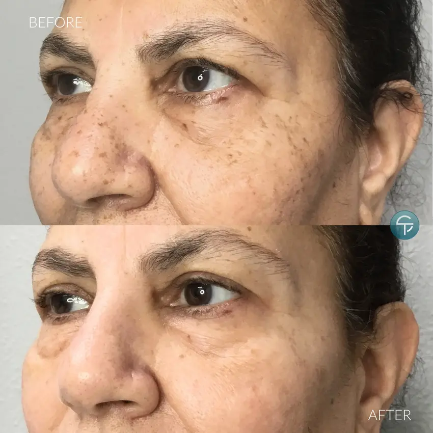 Before and after laser pigment removal treatment for reducing stubborn skin discoloration.