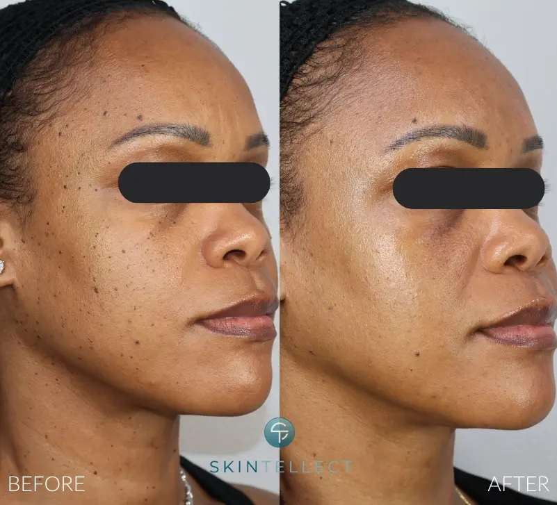 Before and after image showing the removal of Dermatosis Papulosa Nigra (DPN) lesions for smoother, clearer skin.