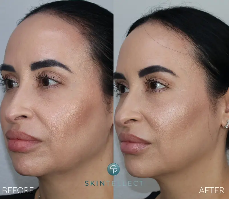 Before and after Botox and dermal filler treatment for cheek and jaw contouring at Skintellect Laser & Aesthetics in Tampa.