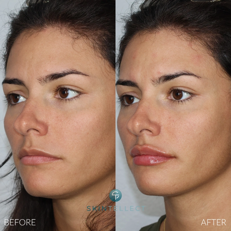 Before and after photo showing lip enhancement with one syringe of dermal filler at Skintellect Laser & Aesthetics in Tampa.