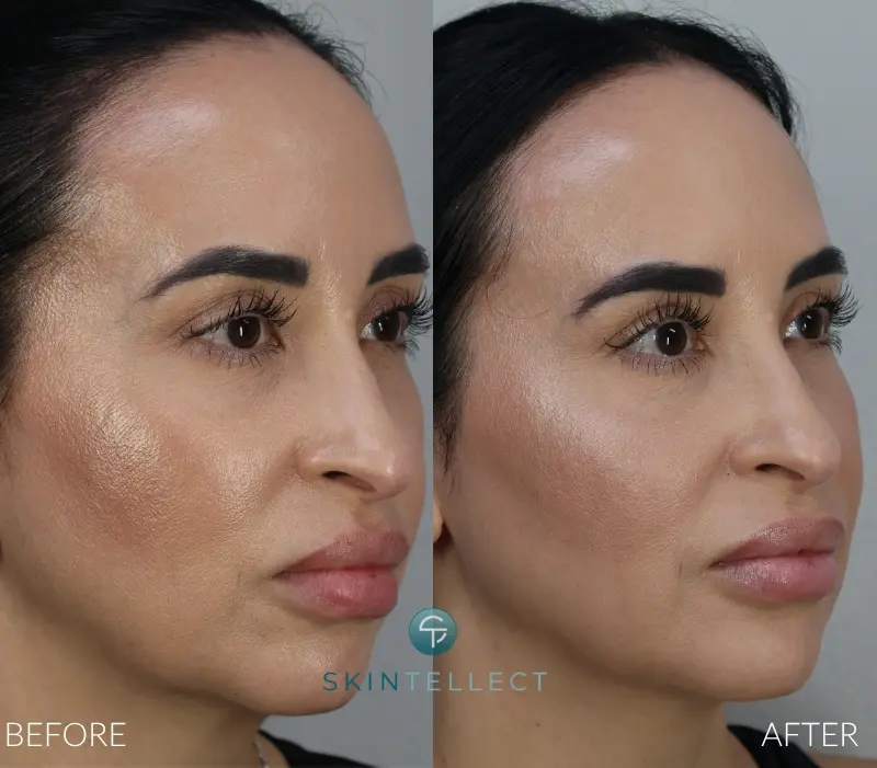 Before and after photo showing Botox and dermal filler treatment for cheek and jawline contouring at Skintellect Laser & Aesthetics in Tampa.