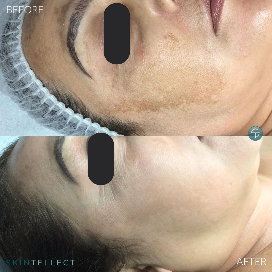 Before and after photo of laser pigment removal on the chest to eliminate sunspots.
