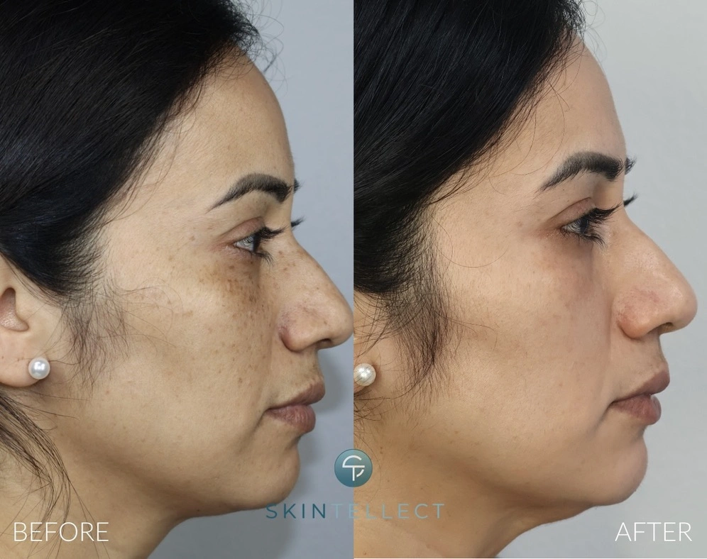 Before and after images of skin rejuvenation with laser pigment removal for sun spots.