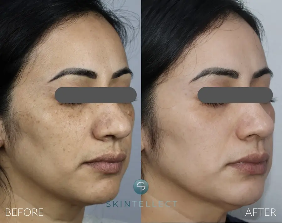 Laser treatment results showing clearer skin after removing unwanted pigmentation.