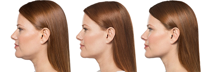 Kybella | 3 treatments