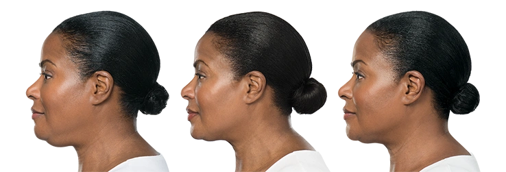 Kybella | 4 treatments