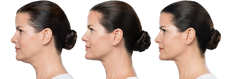 Kybella | 4 treatments