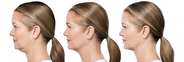Kybella | 4 treatments