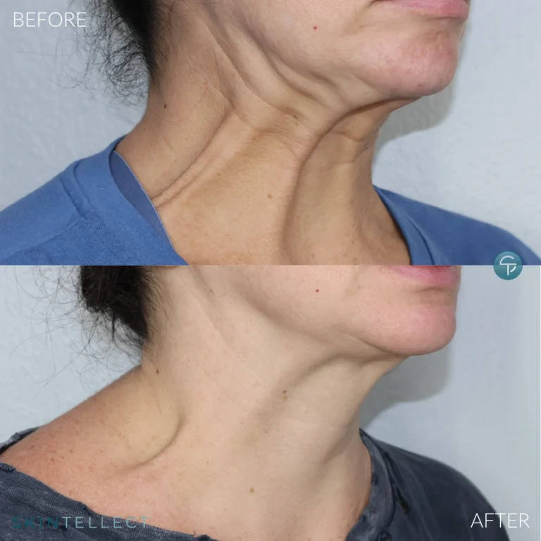 Botox