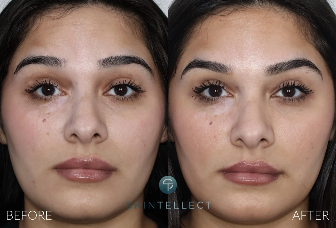 Botox